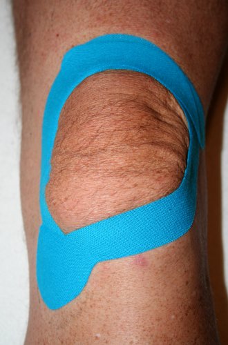 Herpositionering van de knie bij knieklachten
